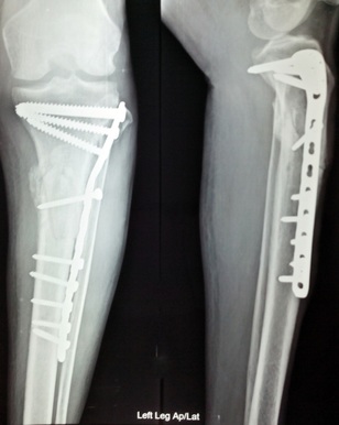 X-Ray of orthopaedic surgery